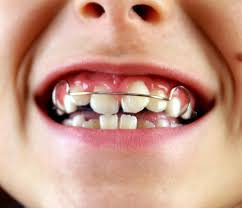 ortodoncia infantil burjassot