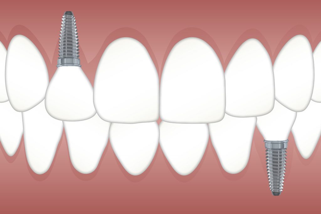 implantes dentales valencia, implantes dentales burjassot, implantes dentales precio burjassot