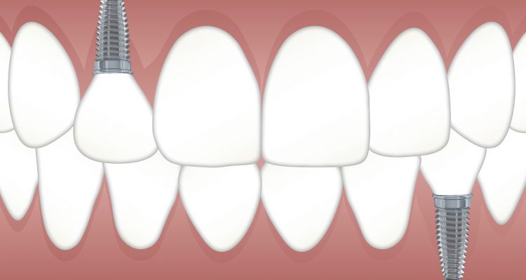 implantes dentales valencia, implantes dentales burjassot, implantes dentales precio burjassot