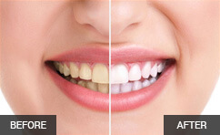 Blanqueamiento dental: verdades y mentiras que debes conocer
