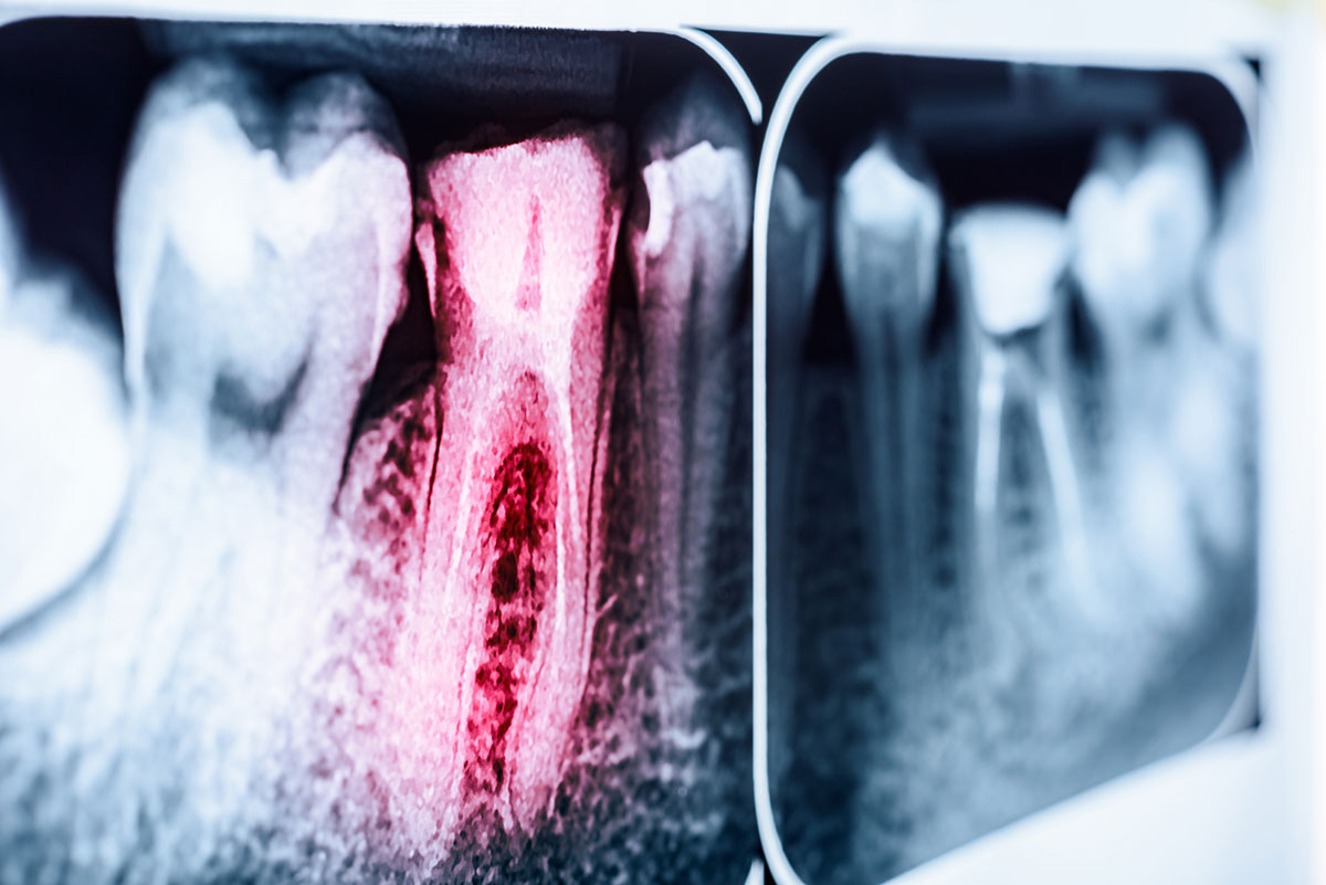 endodoncia burjassot