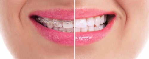 dientes antes y despúes ortodoncia