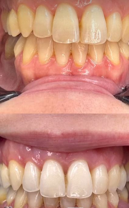 TRATAMIENTO BLANQUEAMIENTO DENTAL
