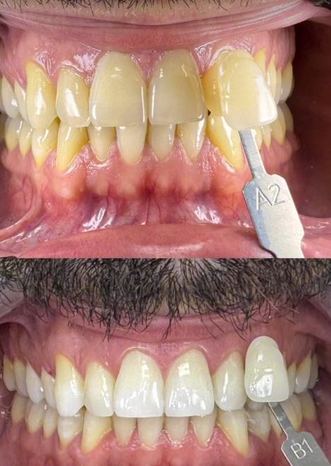 blanqueamiento dental